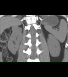 Cystic Renal Cell Carcinoma Right Kidney - CTisus CT Scan