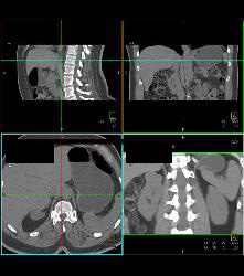 Cystic Renal Cell Carcinoma Right Kidney - CTisus CT Scan