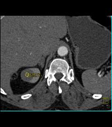 Cystic Renal Cell Carcinoma Right Kidney - CTisus CT Scan