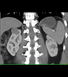 Cystic Renal Cell Carcinoma Right Kidney - CTisus CT Scan