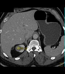 Cystic Renal Cell Carcinoma Right Kidney - CTisus CT Scan