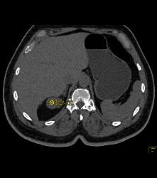 Cystic Renal Cell Carcinoma Right Kidney - CTisus CT Scan