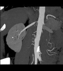 Renal Artery Stenosis. Right Renal Artery to Upper Pole and Stenosis of the Left Renal Artery. - CTisus CT Scan