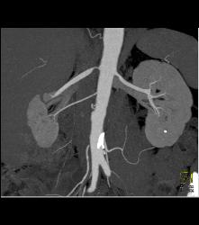 Renal Artery Stenosis. Right Renal Artery to Upper Pole and Stenosis of the Left Renal Artery. - CTisus CT Scan