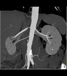 Renal Artery Stenosis. Right Renal Artery to Upper Pole and Stenosis of the Left Renal Artery. - CTisus CT Scan