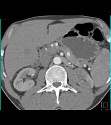 Infarcted Left Kidney Due to Stenosis of Upper Pole Renal Artery - CTisus CT Scan