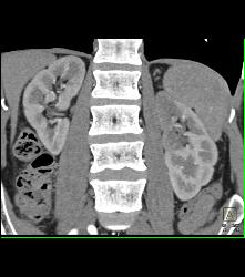 Infarcted Left Kidney Due to Stenosis of Upper Pole Renal Artery - CTisus CT Scan