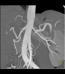 Infarcted Left Kidney Due to Stenosis of Upper Pole Renal Artery - CTisus CT Scan