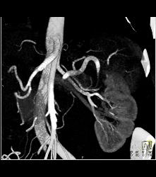 Infarcted Left Kidney Due to Stenosis of Upper Pole Renal Artery - CTisus CT Scan