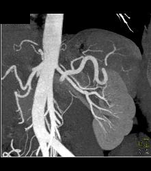 Infarcted Left Kidney Due to Stenosis of Upper Pole Renal Artery - CTisus CT Scan