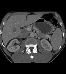 Scarring Left Kidney - CTisus CT Scan