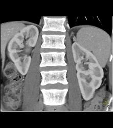 Scarring Left Kidney - CTisus CT Scan