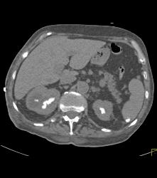 Staghorn Calculi With Papillary Necrosis - CTisus CT Scan