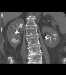 Staghorn Calculi With Papillary Necrosis - CTisus CT Scan