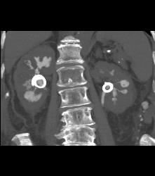 Staghorn Calculi With Papillary Necrosis - CTisus CT Scan