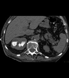 Staghorn Calculi With Papillary Necrosis - CTisus CT Scan