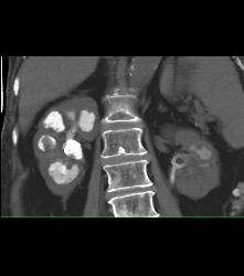 Staghorn Calculi With Papillary Necrosis - CTisus CT Scan