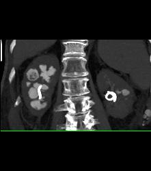 Staghorn Calculi With Papillary Necrosis - CTisus CT Scan