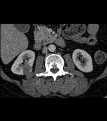 High Density Renal Cyst - CTisus CT Scan