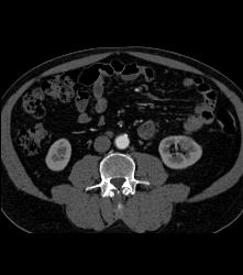 1cm Left Renal Cell Carcinoma - CTisus CT Scan