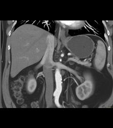 1cm Left Renal Cell Carcinoma - CTisus CT Scan