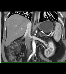 1cm Left Renal Cell Carcinoma - CTisus CT Scan