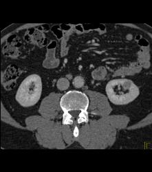 1cm Left Renal Cell Carcinoma - CTisus CT Scan