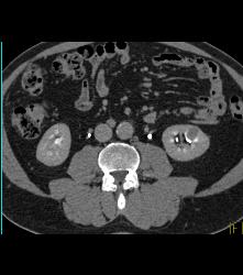 1cm Left Renal Cell Carcinoma - CTisus CT Scan