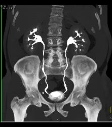 1cm Left Renal Cell Carcinoma - CTisus CT Scan