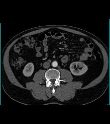 1cm Left Renal Cell Carcinoma - CTisus CT Scan