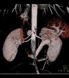 Retro-aortic Left Renal Vein - CTisus CT Scan