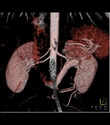 Retro-aortic Left Renal Vein - CTisus CT Scan