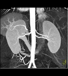 Retro-aortic Left Renal Vein - CTisus CT Scan