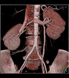 Normal Left Gonadal Vein in 3D - CTisus CT Scan