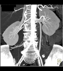 Normal Left Gonadal Vein in 3D - Kidney Case Studies - CTisus CT Scanning