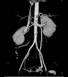 Normal Left Gonadal Vein in 3D - CTisus CT Scan