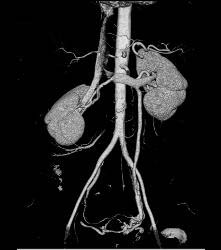 Normal Left Gonadal Vein in 3D - Kidney Case Studies - CTisus CT Scanning