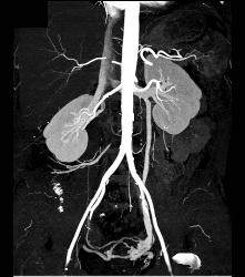 Left Gonadal Vein With Pelvic Collaterals - CTisus CT Scan