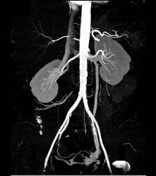 Left Gonadal Vein With Pelvic Collaterals - CTisus CT Scan