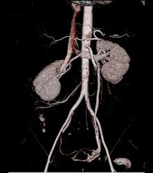 Left Gonadal Vein With Pelvic Collaterals - CTisus CT Scan