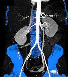 Left Gonadal Vein With Pelvic Collaterals - CTisus CT Scan