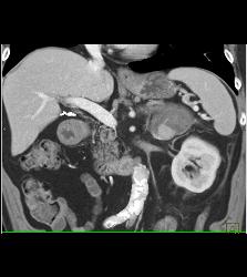 Bleed in Left Adrenal Gland That Has A Metastases From Renal Cell Carcinoma - CTisus CT Scan