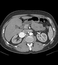 Right Renal Artery Aneurysm - CTisus CT Scan