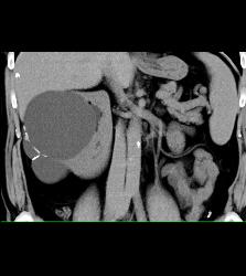 Complex Right Renal Cyst - CTisus CT Scan