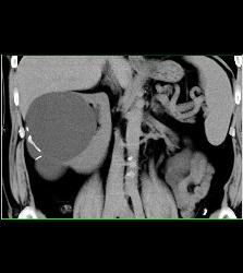 Complex Right Renal Cyst - CTisus CT Scan