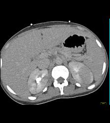 Bilateral Acute Pyelonephritis - CTisus CT Scan