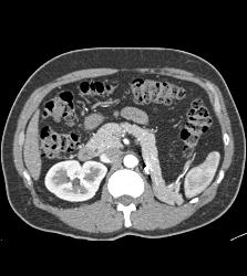 Normal Post Left Nephrectomy Bed - CTisus CT Scan