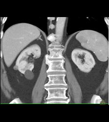 Renal Cysts Including 1 Cm High Density Right Renal Cyst - CTisus CT Scan