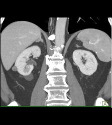 Renal Cysts Including 1 Cm High Density Right Renal Cyst - CTisus CT Scan