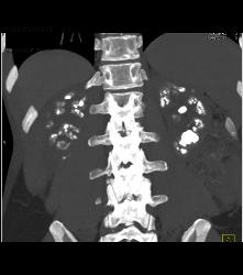 Medullary Sponge Kidney - CTisus CT Scan